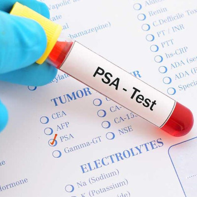 Portable Prostate Cancer Test May Help Reach Underserved Men