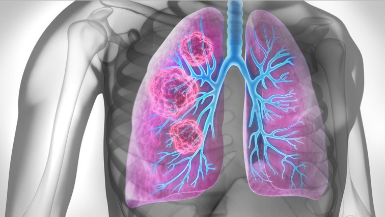 Nanoparticle Vaccine Could Curb Cancer Metastasis to Lungs by Targeting a Protein