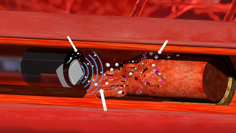 Nanodroplets and Ultrasound ‘Drills’ Prove Effective at Tackling Tough Blood Clots