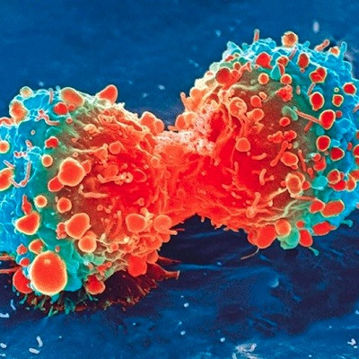 Boosting Anti-cancer Action by Driving up Immunity at Tumor Site