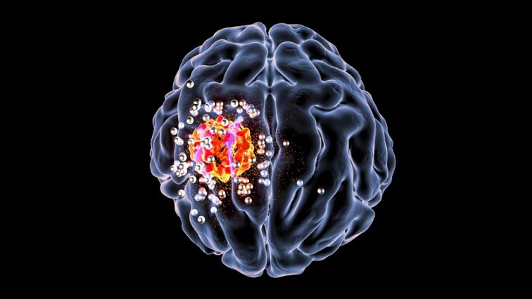 Small but Mighty! Nanoparticles May Hold Key in Brain Cancer Treatment