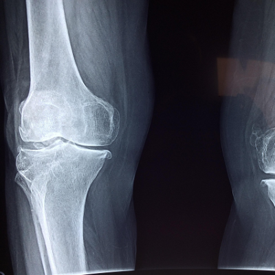 Orthopaedic Implants Aim to Last Longer