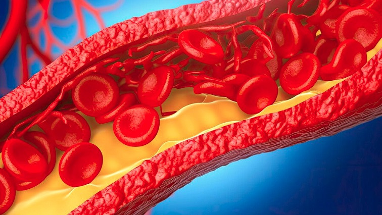 3D In Vitro Human Atherosclerosis Model for High-throughput Drug Screening