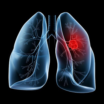 Detection of Lung Cancer Aided by a Simple Blood Test