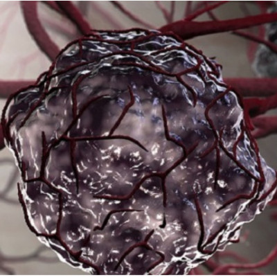 Point-of-Care Test Developed for Tumor Marker in Human Saliva Based on Lanthanide Nanoprobes