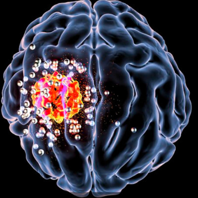 Nanoparticles Deliver Brain Cancer Treatment