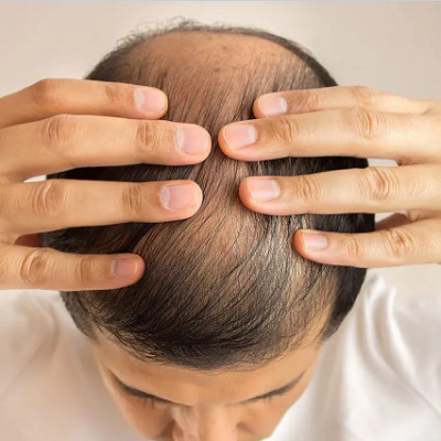 AI Helps Researchers Design Microneedle Patches That Restore Hair in Balding Mice