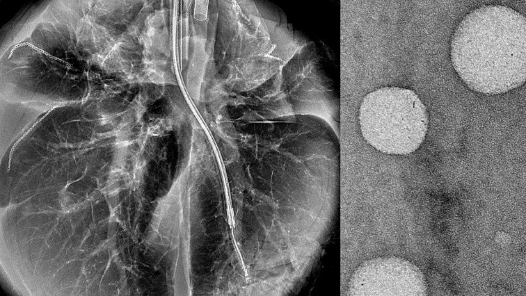 Delivering Gene Therapy to the Lung Using Nanoparticles