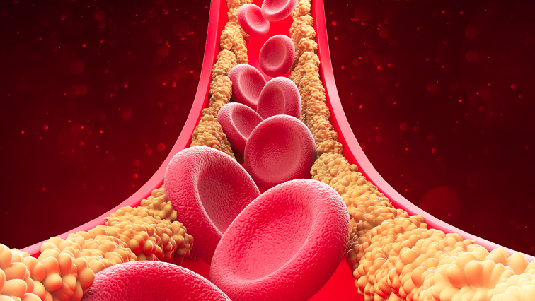 Nanoparticles Engineered to Suck the Plaque Out of Arteries