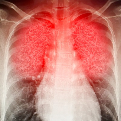 Penn Medicine Researchers Develop Structural Blueprint of Nanoparticles to Target White Blood Cells Responsible for Acute Lung Inflammation
