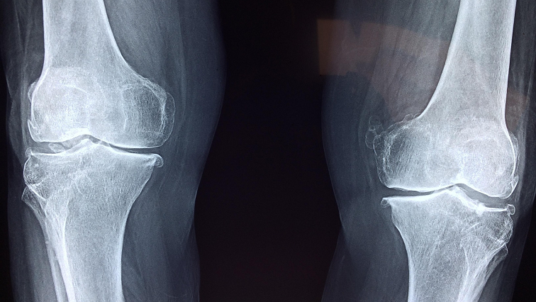 Orthopaedic Implants Aim to Last Longer