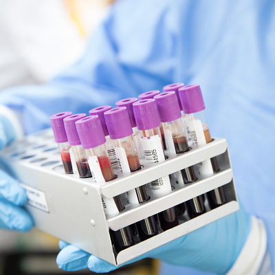 Breakthrough in Blood Test for Alzheimer’s by University of York Researchers