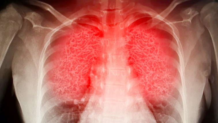Penn Medicine Researchers Develop Structural Blueprint of Nanoparticles to Target White Blood Cells Responsible for Acute Lung Inflammation