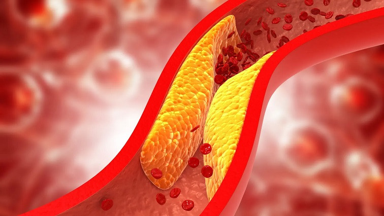 NUS Medicine Researchers Develop Breakthrough Nanoparticle Technology for Targeted Diagnosis and Treatment of Atherosclerosis