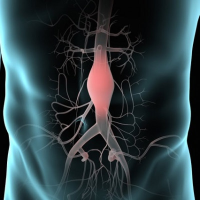 Nanomedicine Research Aims to Transform Treatment of Aortic Aneurysms