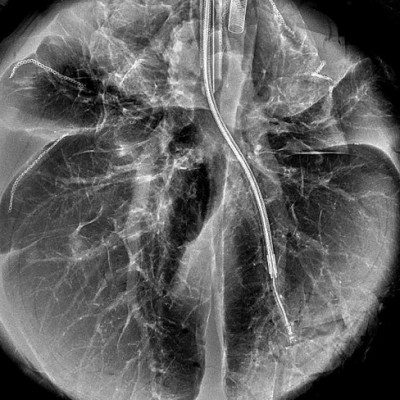 Delivering Gene Therapy to the Lung Using Nanoparticles