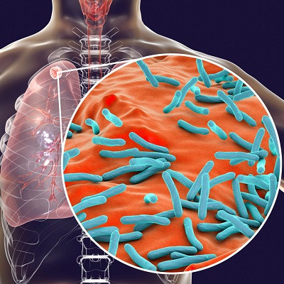 Nanoparticles with Antibacterial Action Shorten Duration of Tuberculosis Treatment