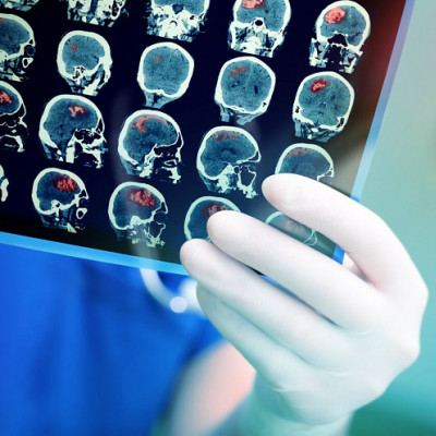 Fast-tracked: First In-human Trial for Aggressive Brain Tumours