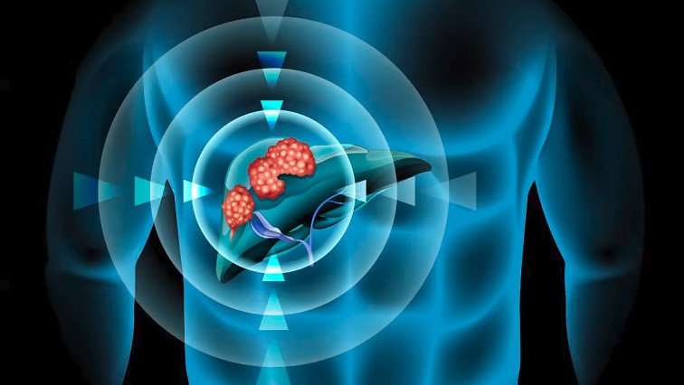 Treating Liver Cancer with Microrobots Piloted by a Magnetic Field
