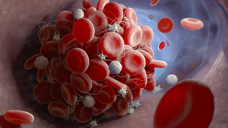 Targeted Photothermal Treatment for Blood Clots Shows Promise