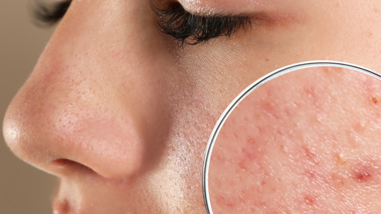 Tiny Nanocarriers Could Prove the Magic Bullet for Acne Sufferers