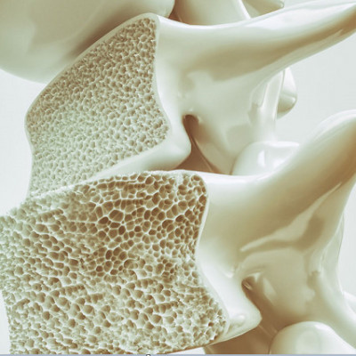 Using Nanoscience to Treat Osteoporosis