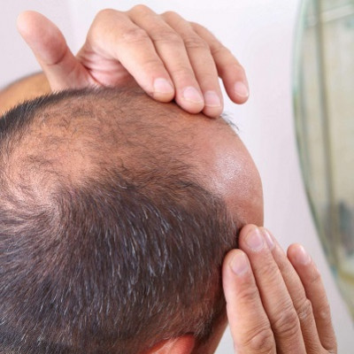 Treating the ‘Root’ Cause of Baldness with a Dissolvable Microneedle Patch