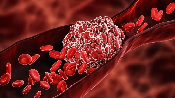 The potential impact of nanomedicine on COVID-19-induced thrombosis.