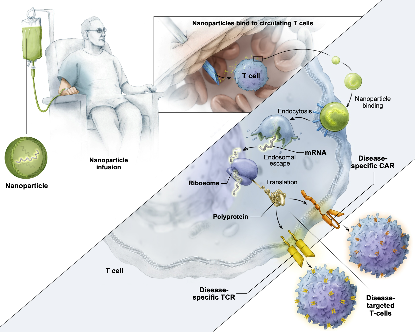 Engineered nanoparticles filled with mRNA and coated with antibodies target a patient’s T cells
