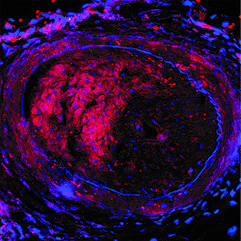 Injured control artery treated with near infrared florescent protein, depicts restenosis in center