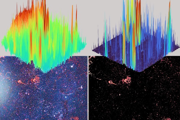 Background noise (left) obscures the presence of TB membrane components in blood. At right, AI has removed noise, confirming diagnosis.