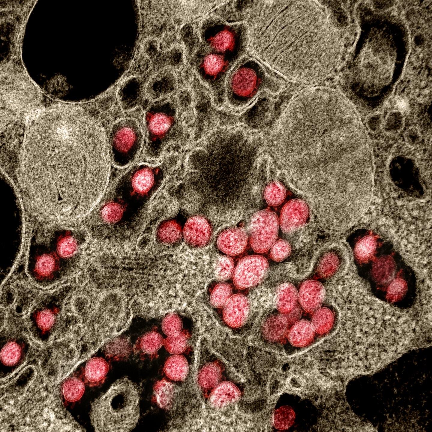 electron micrograph of SARS-CoV-2 virus