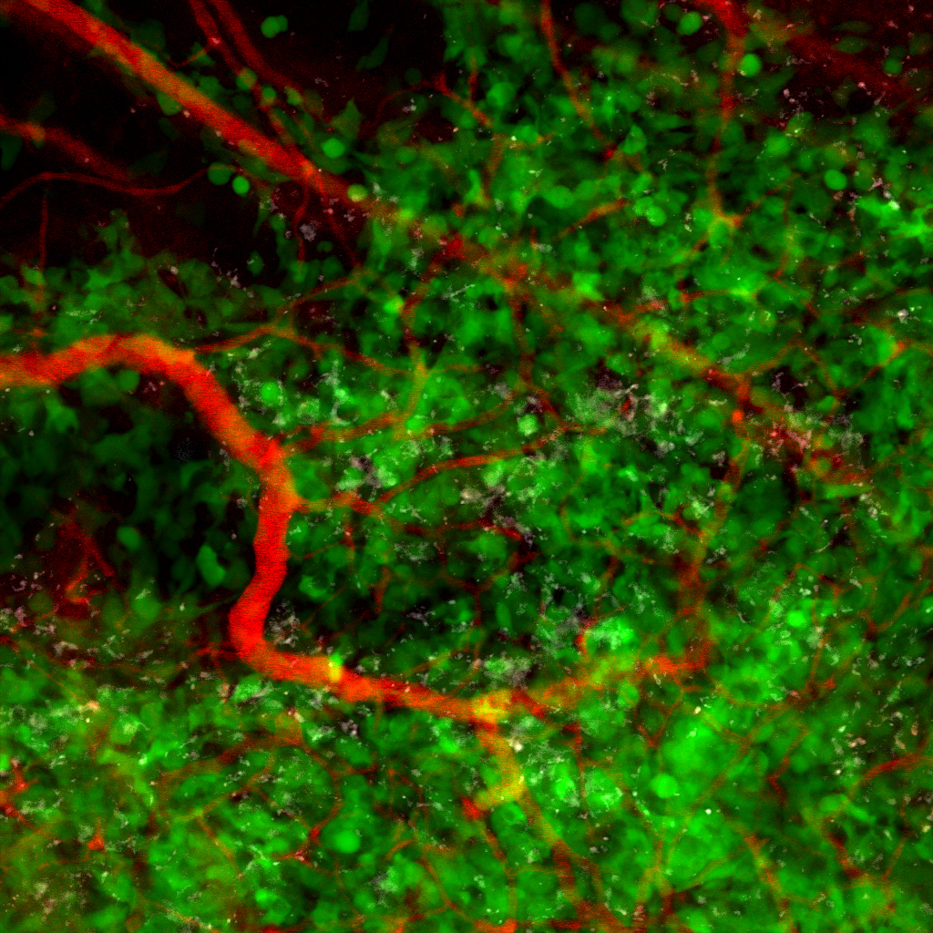 The green tumor cells and red blood vessels in this microscope image, taken inside a living mouse, are easy to spot. But a closer look reveals small gray specks, which are monocytes and macrophages advancing on the tumor. Courtesy of Bryan Smith.