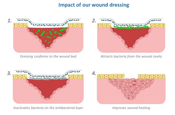 An example of how wound dressings work.