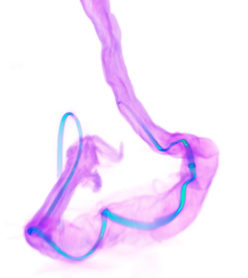 An X-ray CT image shows a NeuroString (blue) sensor implanted in a colon (purple)