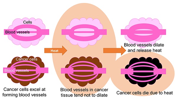 How thermotherapy works. The therapeutic mechanism exploits cancer tissue's tendency to accumulate heat