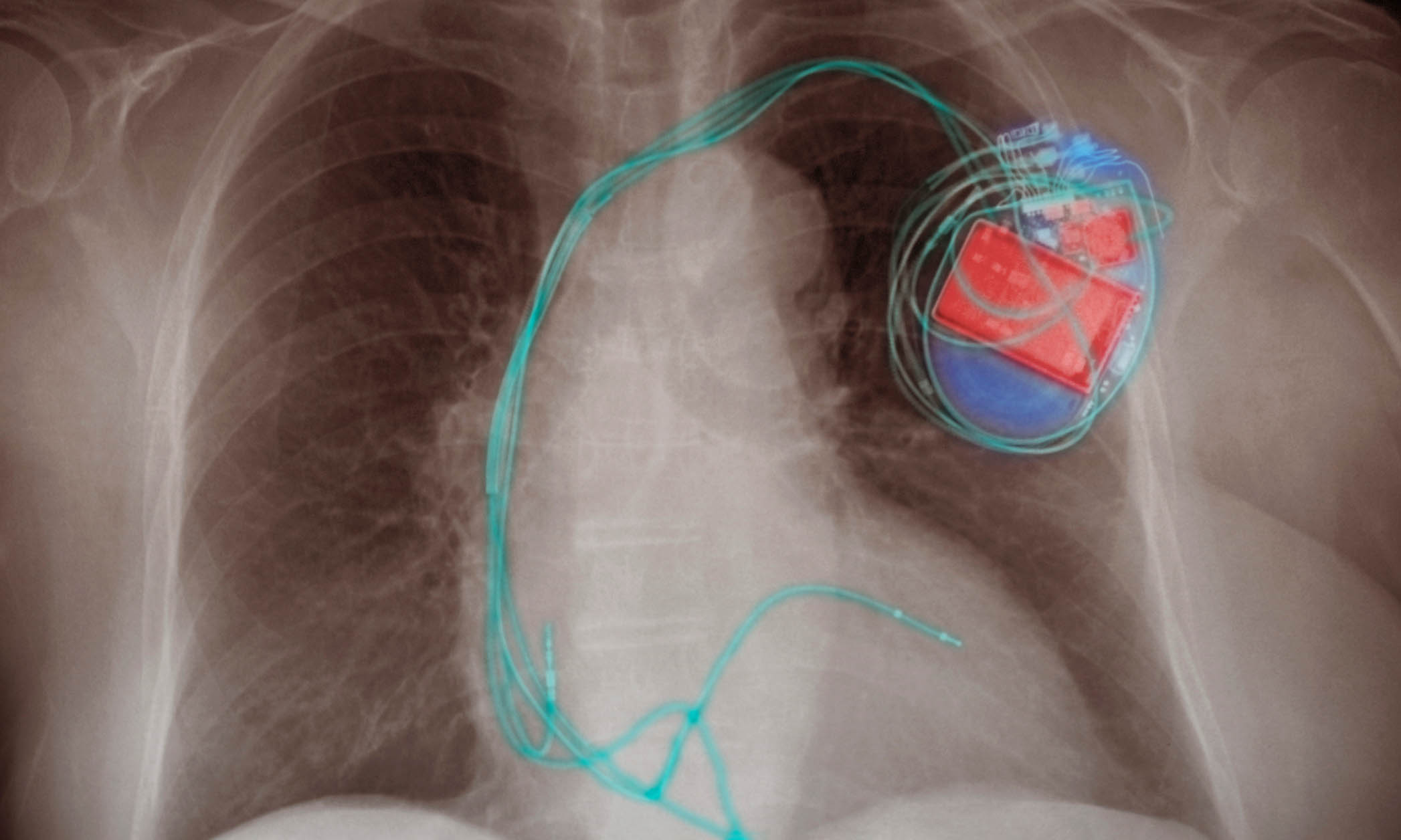 convert blood pressure into a power source for pacemakers
