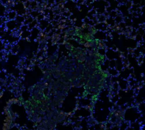 This image visualizes the tumor microenvironment in a lung metastasis mouse model, with two different types of T cells (shown in red and green)